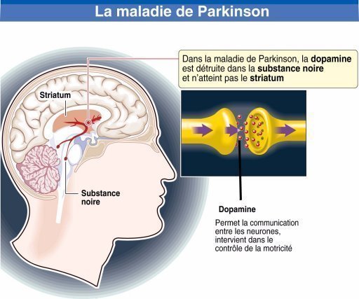 Parkinson: Cellules Tueuses De Neurones Impliquées - Le Petit Monde D ...